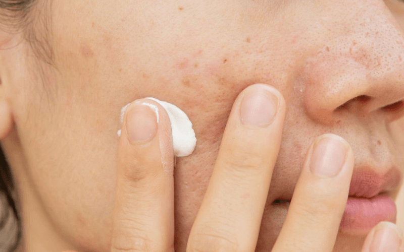 How to Care for Acne-Prone Skin This Summer?